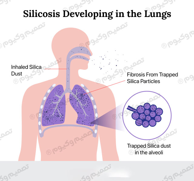 گردوغبار سیلیسِ استنشاق‌شده